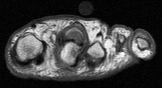 Figure 5 for case Plantar plate rupture